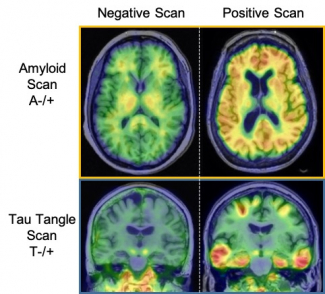 PET scans showing amyloid and tau