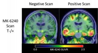 two brain imaging scans, one on the left showing a negative tau PET, one on the right showing a positive tau PET
