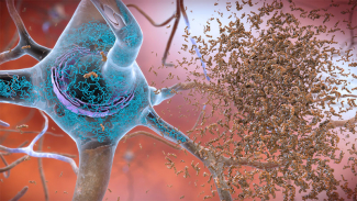 illustration of amyloid in the human brain