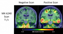 two brain imaging scans, one on the left showing a negative tau PET, one on the right showing a positive tau PET